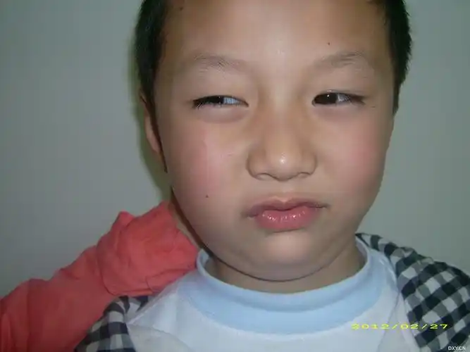 【斜视讨论】患儿6岁,出生后3个月出现头部歪斜.