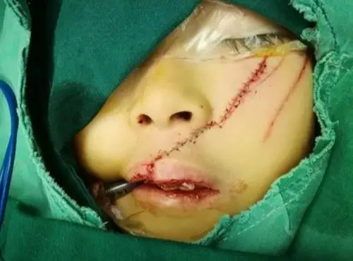 太原6岁女童被精神病患者砍伤!万人相助,爱心汇集逾23万元!