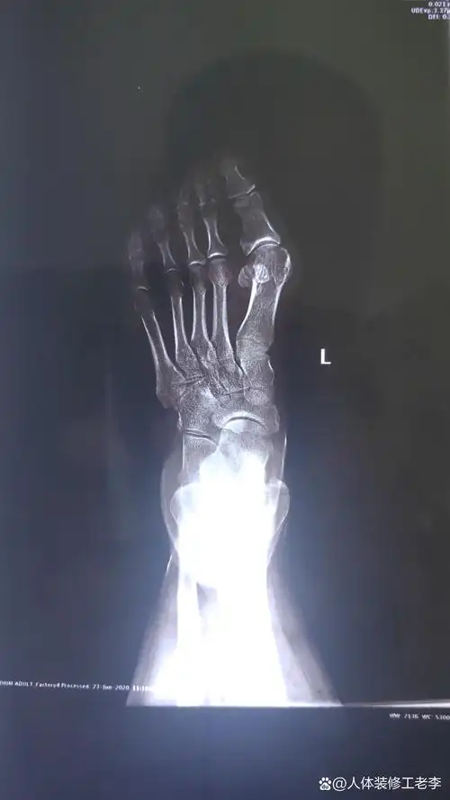 做拇外翻手术主要以第一跖列的截骨为主 矫正偏斜的第一跖列的骨头