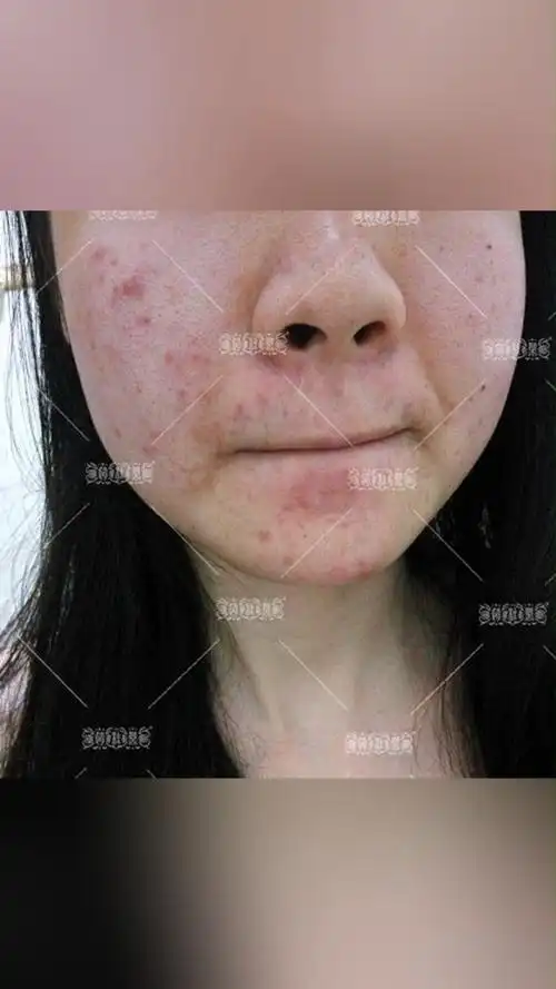 赵桂荣专业解决敏感肌皮肤屏障受损等问题