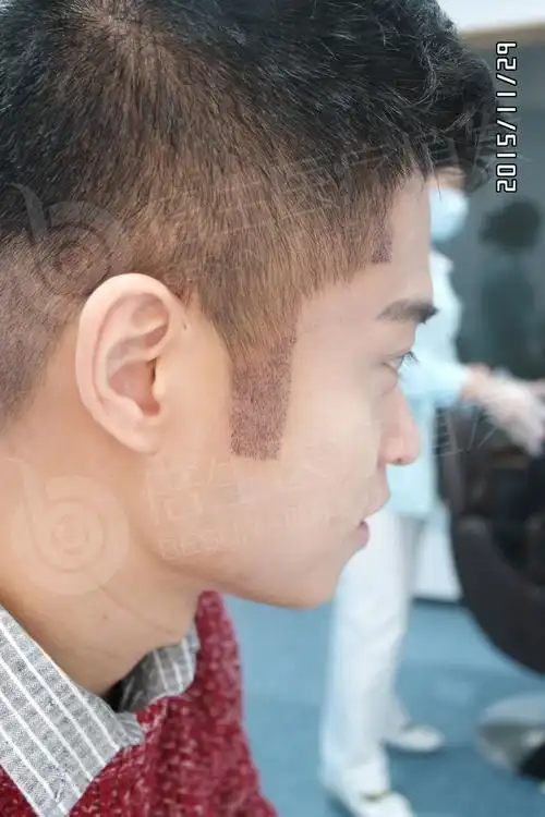 刘先生鬓角种植800单位效果展示