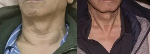 甲亢的早期脖子图片 (6)