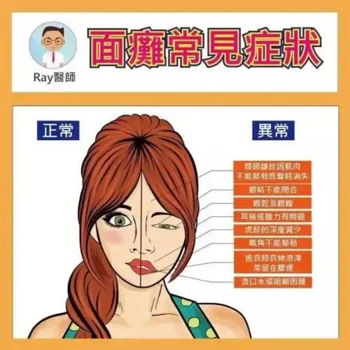 带你了解面瘫