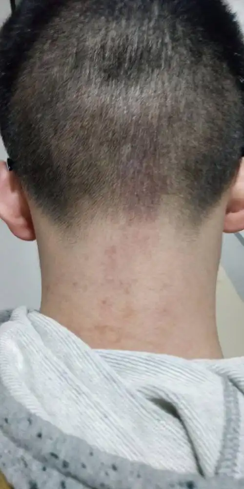 头部有红色区域,一片,不痛不痒,同学说看我这样好几天了