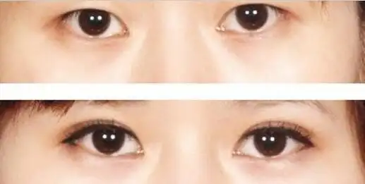 单眼皮割双眼皮价格和果图