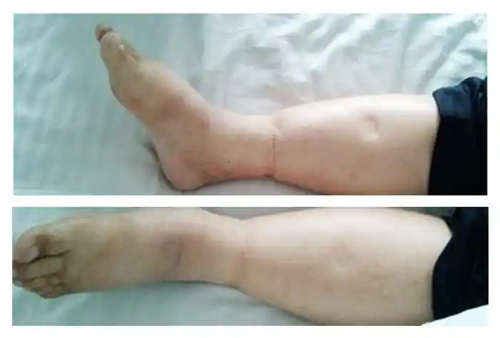 糖尿病肾病腿部水肿图片