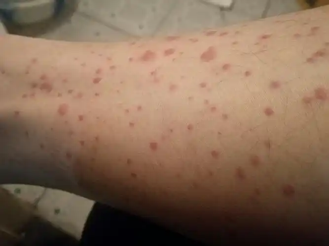 近期腿上起这样的红点,只有下身有,前些日子什么也没擦好了,但前星期