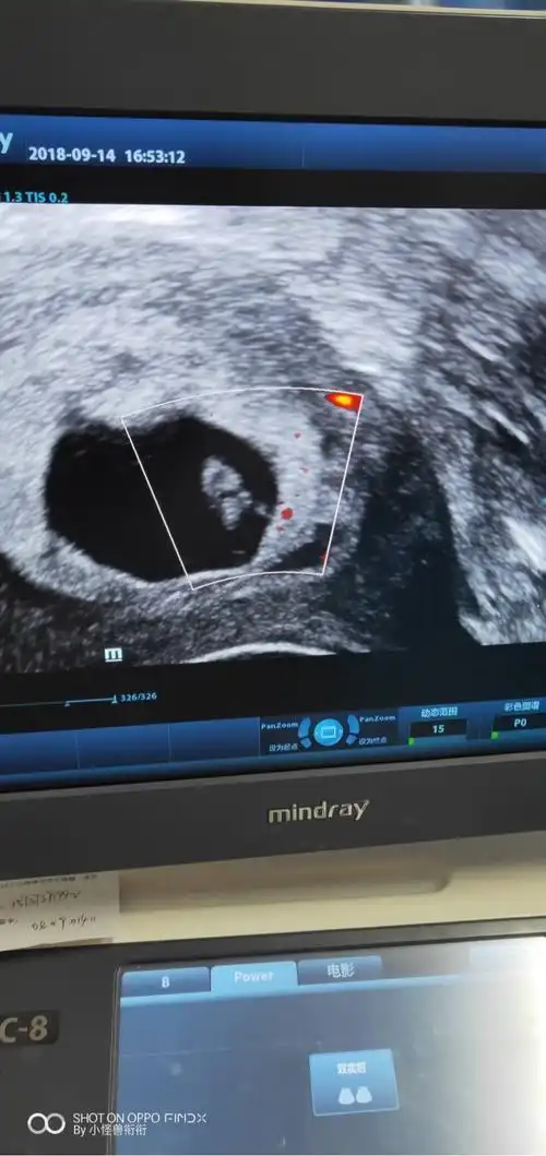 胎芽3毫米还没胎心正常吗让在等一星期看看