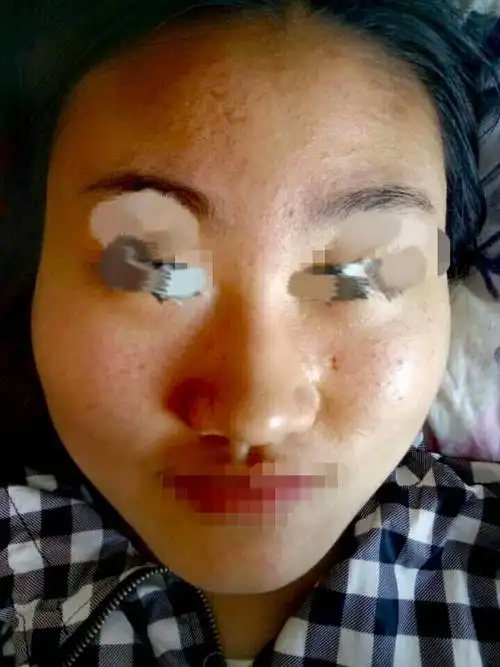 亲们,我是混合型皮肤,满脸都是闭合型粉刺,好想缓解一下 求一款