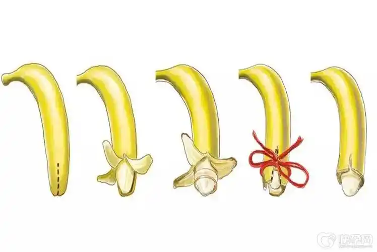 小孩子做包茎手术几岁合适听听生殖专家怎么说