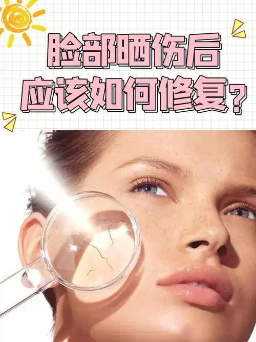 脸部晒伤后应该如何修复
