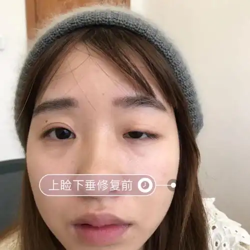 7878上睑下垂二次修复恢复三个月了