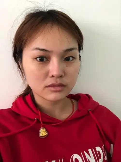 我的颧骨外凸,很难看,额头扁平,整个脸部就很平,没_圈子-新氧美容整形