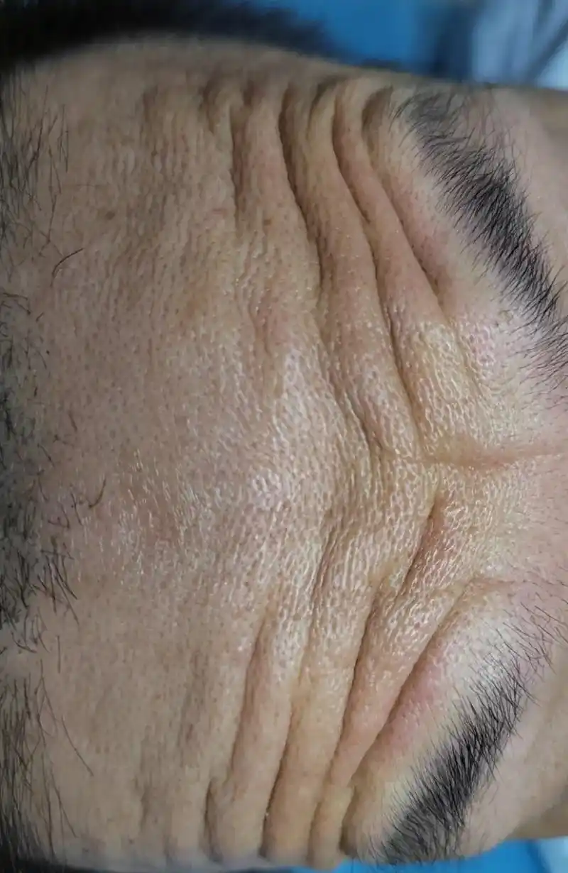 皱纹可以医学美容解决.#皮肤科纪秀军主任医师工作室 #解决皮 - 抖音