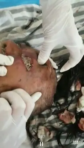 微信里面传播眼睛长虫子的那个人怎么回事?真的假的啊?