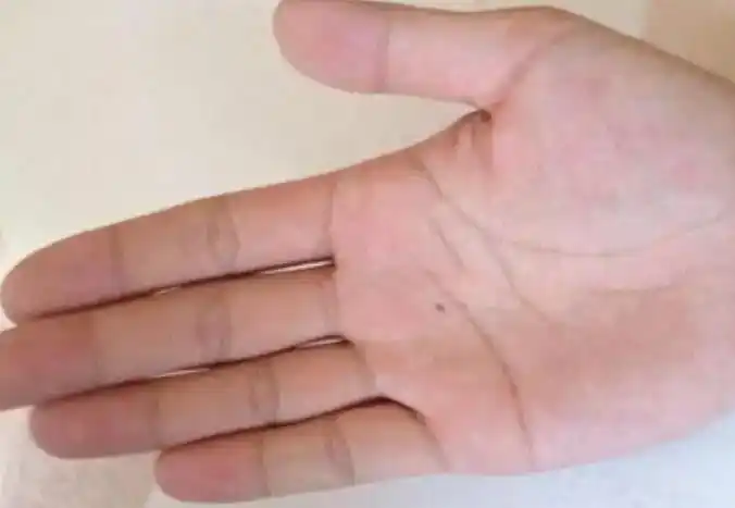 掌心有痣的男人 什么是善痣和恶痣
