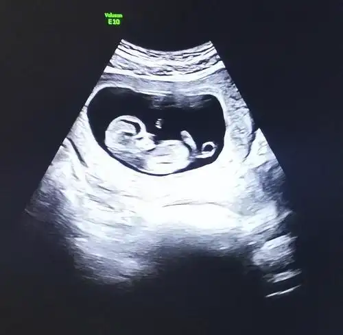 11周b超图,我老公说咋还有小尾巴,怀了个孙悟空吗,快笑死