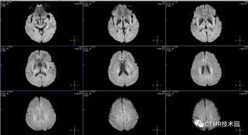 手把手教你基础颅脑mr平扫及后处理