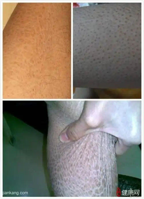 疾病大全 皮肤科 鱼鳞病 发布时间:2014-07-12 10:43:43    鱼鳞病