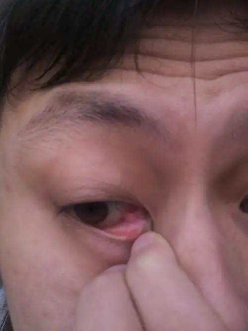 右眼眼角长了个不疼不痒无任何异味的疙瘩,硬硬的,跟黄豆大小差不多