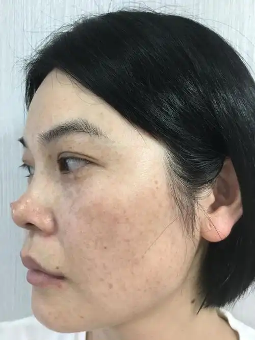 脸上长黄褐斑别急,不妨常吃2种蔬果,建议了解一下