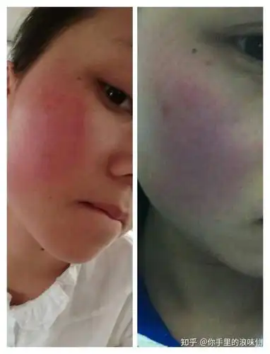 脸上红血丝严重怎么办?