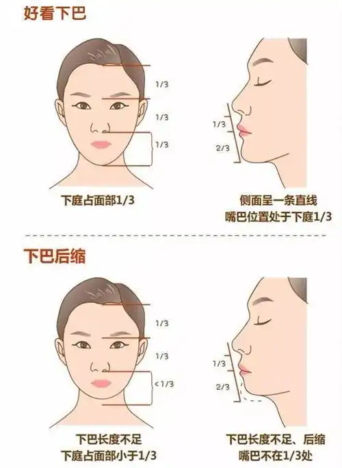 那么解决下巴后缩,有什么方法呢?而面部轮廓中,下巴决定了你的脸型.