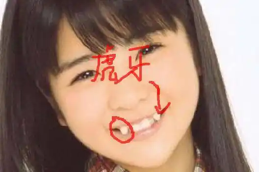 虎牙即犬齿,指唇侧错位的尖牙,它突出于牙弓之外.