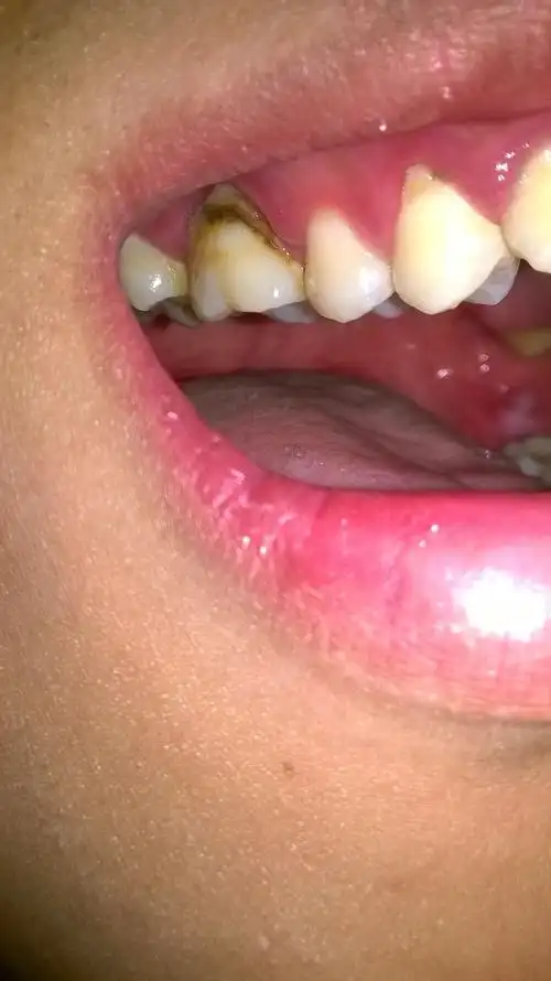 这个龋齿严重吗?需要做根管什么的吗