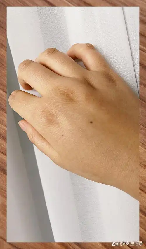 手背痣寓意未来福泽深长