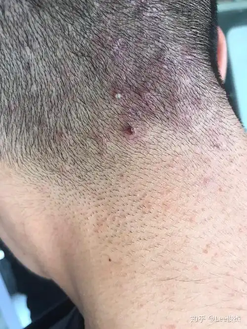 头部毛囊炎三年了反复多次