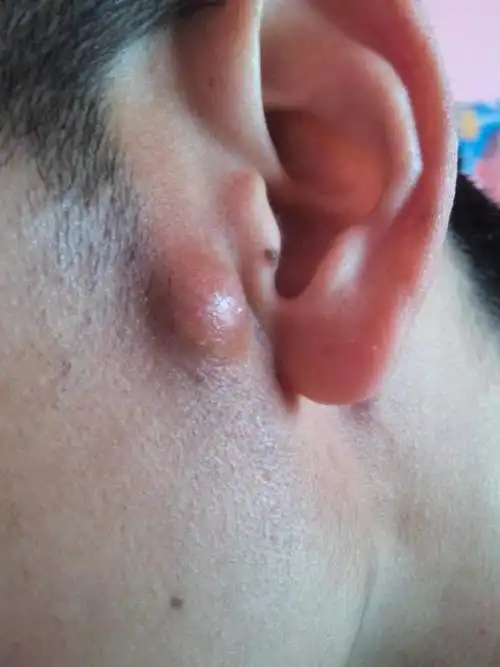 请问我的脸上张了个肉疙瘩是怎么回事啊