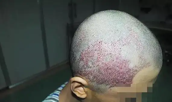 20岁头顶疤痕秃发1905单位完美改变