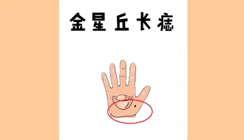 金星丘长痣金星丘是大拇指下,手掌最厚实的位置,这个地方有痣说明你的