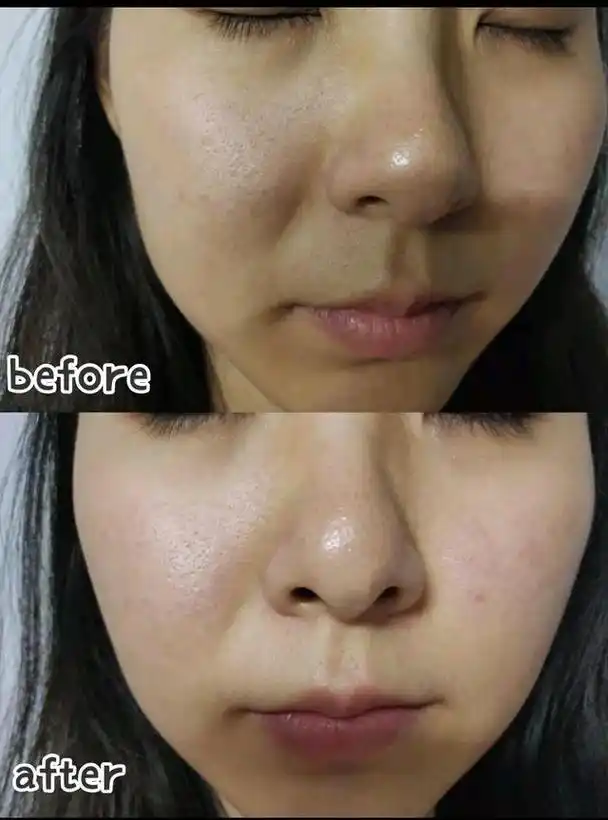 无针vs有针水光,有针水光针真的是绝绝子!