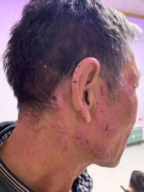 《关于慢性日光性皮炎》 - 皮肤病