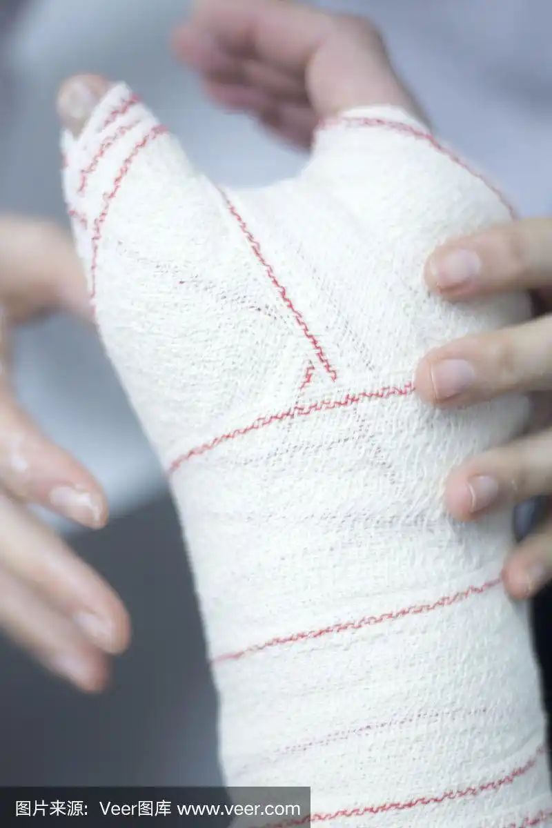 骨折后,医生在患者前臂和手腕上使用石膏石膏和绷带固定.