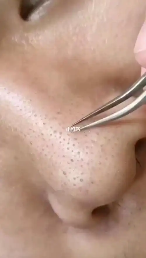 每个毛孔里堵满了黑头粉刺,这就是你们毛孔粗大堵塞,皮肤经常出油的