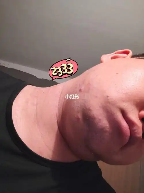 过敏体质还去吃的下场