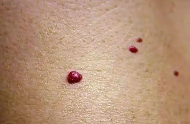 什么是朱砂痣?它是肝硬化的信号吗?今天就给大家科普一下!