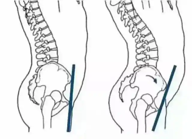 产后盆骨修复不为美不为瘦只为健康