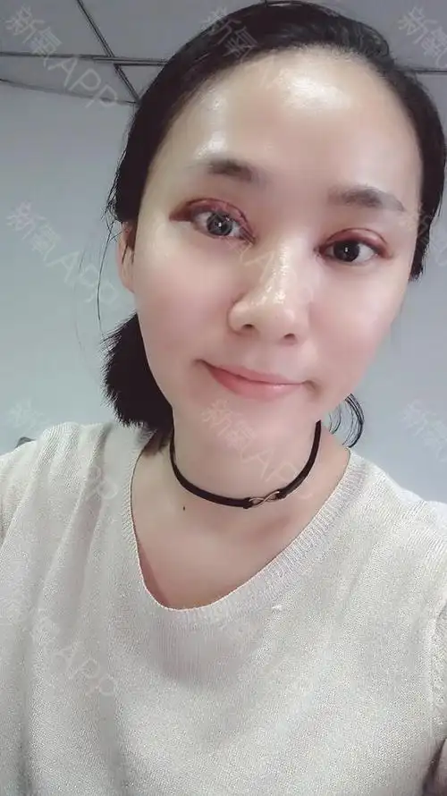 wakcs定点双眼皮术后第2天美丽日记_新氧整形