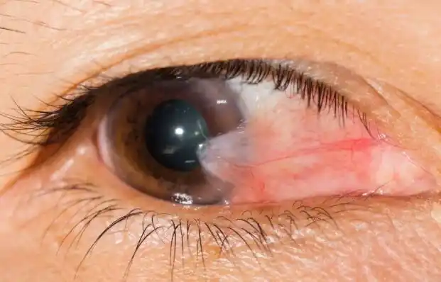 眼部翼状胬肉,您需要的手术常识