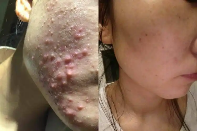 扒一扒我祛痘成功的经验,和5年辛酸祛痘史!