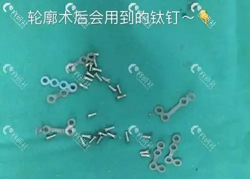 做完颧骨有钉子可以做热玛吉吗取钛钉面部会下垂吗