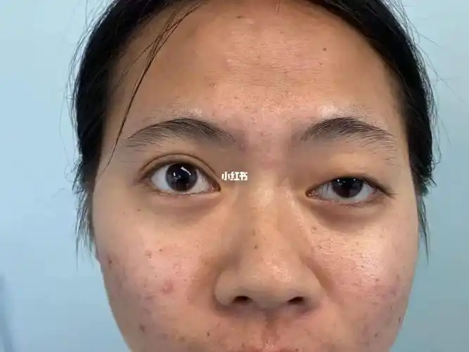 上睑下垂难做,2个小时调个眼睛,心情大好_双眼皮手术_美妆_医美整形