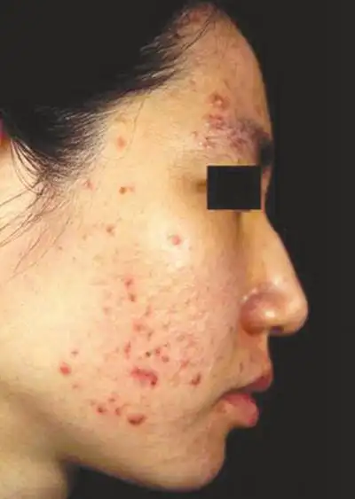 血热的症状痘痘图片8