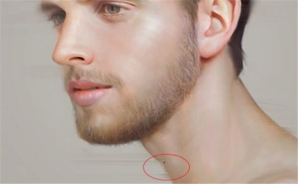 脖子上面长痣的女人情况分析