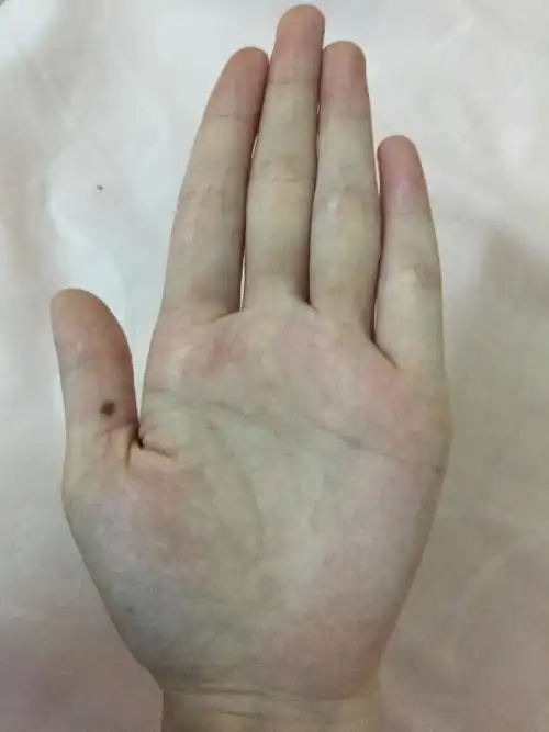 我是女生 左手大拇指心有一颗不是棕色的痣代表着什么?