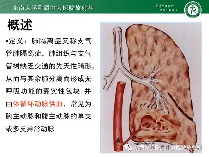 肺隔离症影像表现